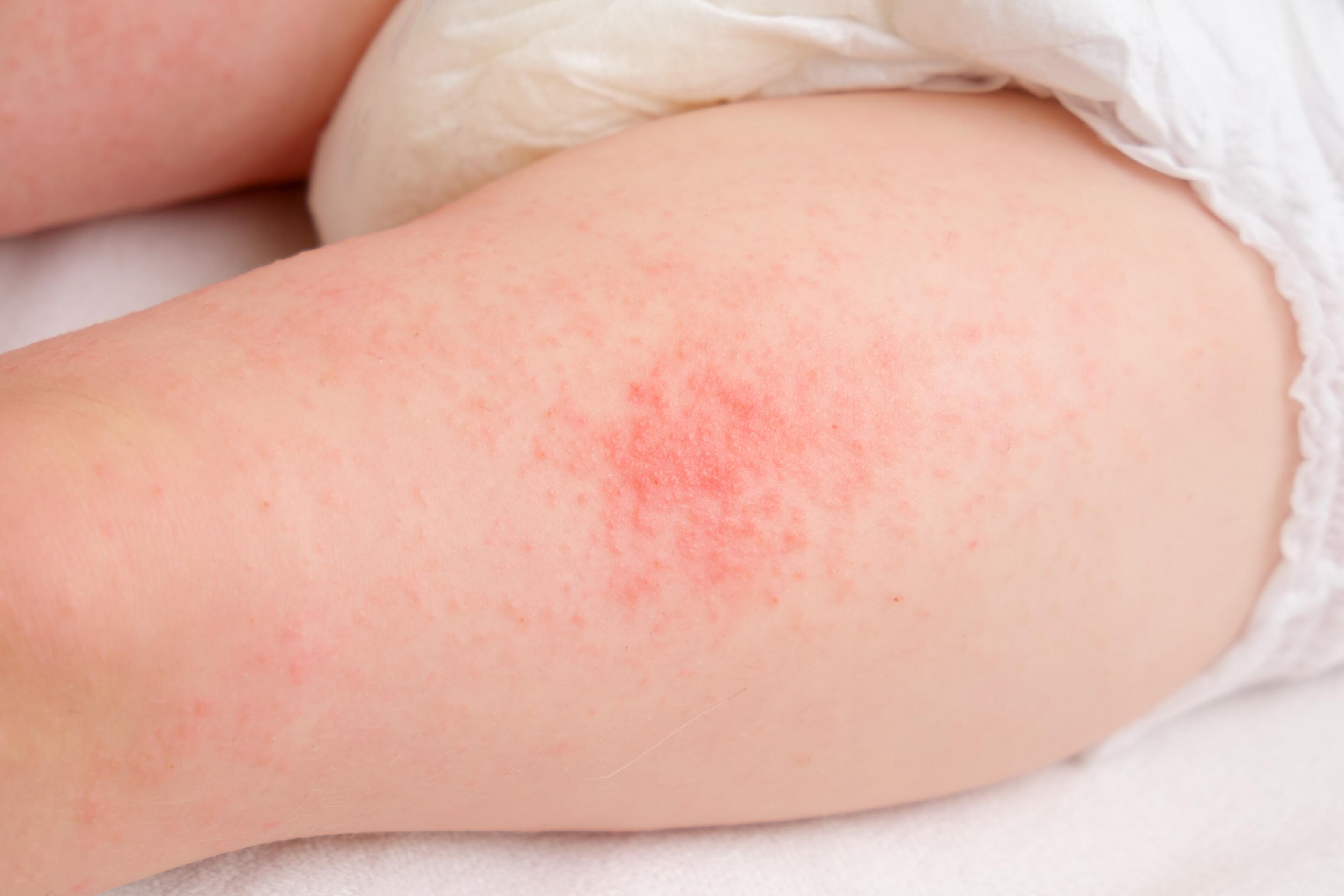 Baby with eczema spots on his leg